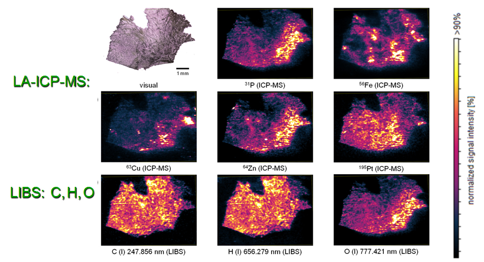 Bio-imaging of human tumor sample using Tandem LA – LIBS with LIBS to provide complementary information about organic elements